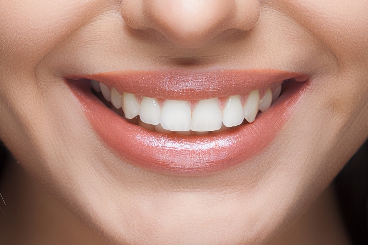 Can I Whiten My Teeth If I Have Fillings or Crowns?